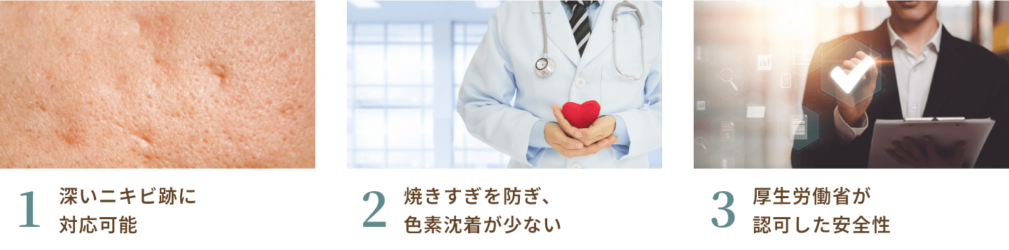 アキュパルスの特徴