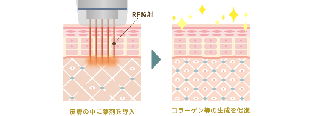 トライアル価格