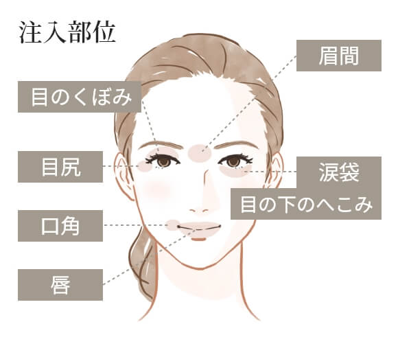 ボルベラの注入部位