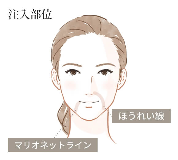 ボリフトの注入部位