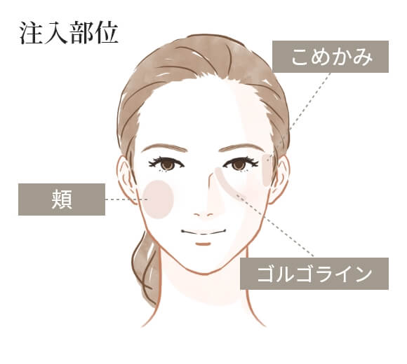 ボリューマの注入部位