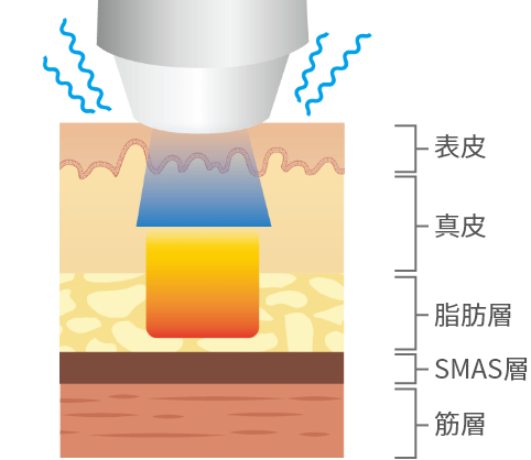 RF高周波治療