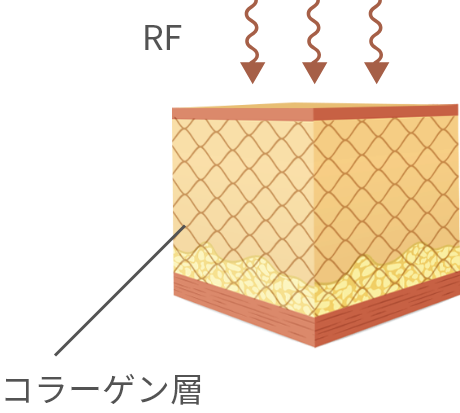 IPLを照射