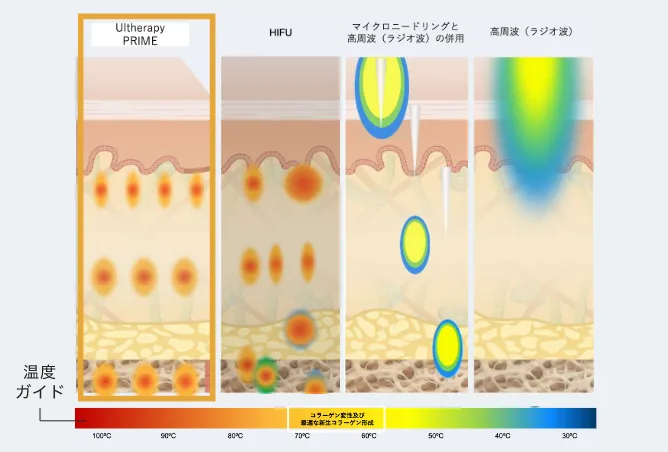 Ultherapy PRIME、HIFU、モノポーラRF、高周波の熱エネルギー到達イメージ比較