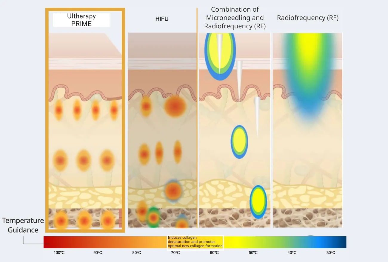 Ultherapy PRIME、HIFU、モノポーラRF、高周波の熱エネルギー到達イメージ比較